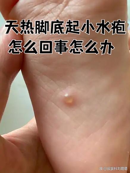 脚底长了像水泡一样的东西很痒是怎么回事