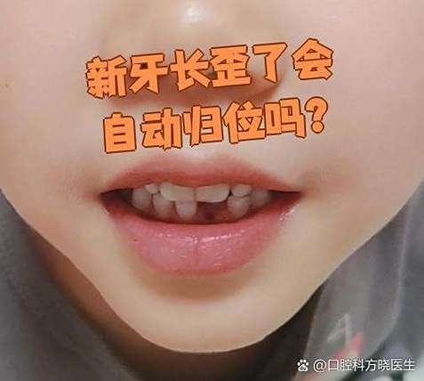 牙齿长歪了可以磨掉吗