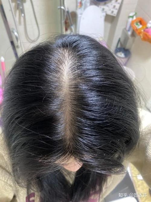 发旋头发少是脱发吗