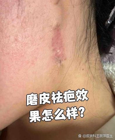 磨皮手术去哪里做