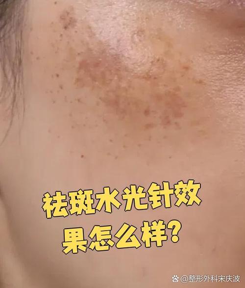 水光祛斑真的有用吗