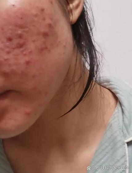 当女生说她长痘痘缩略图