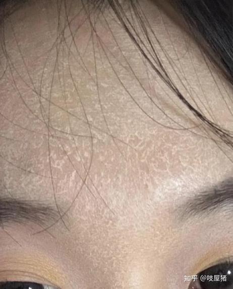 蜕皮与褪皮的区别截图