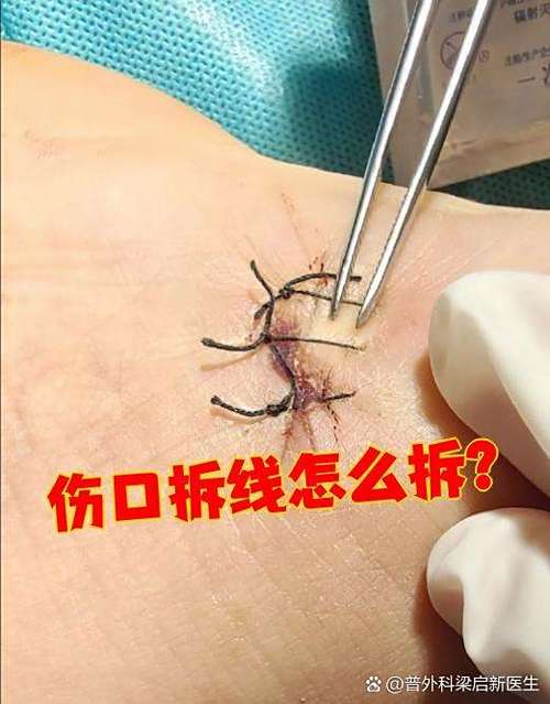 缝完针拆线疼吗游戏截图