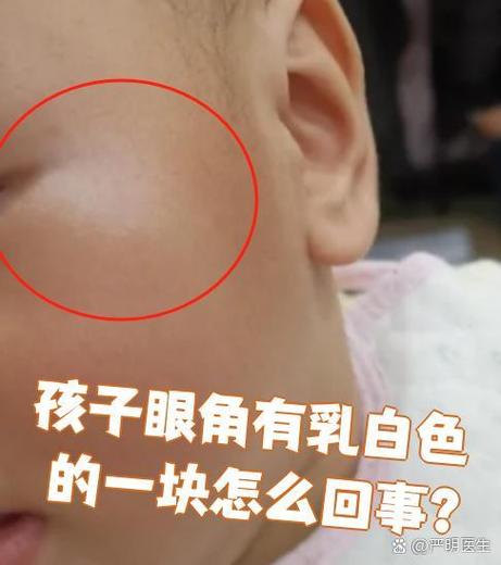 眼角出现白斑什么原因游戏截图