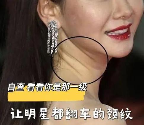 如何把颈纹怎么消除