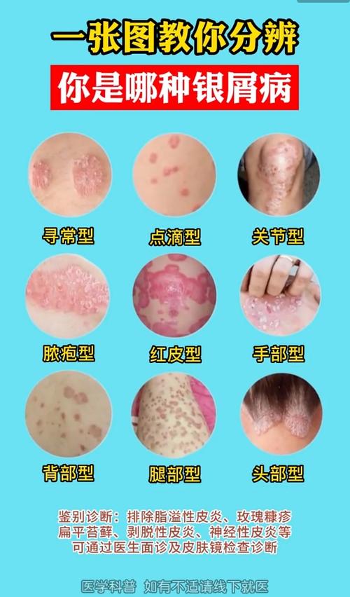 皮肤病大全图