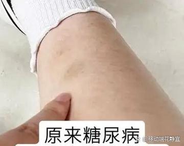 怎么判断自己是糖尿病
