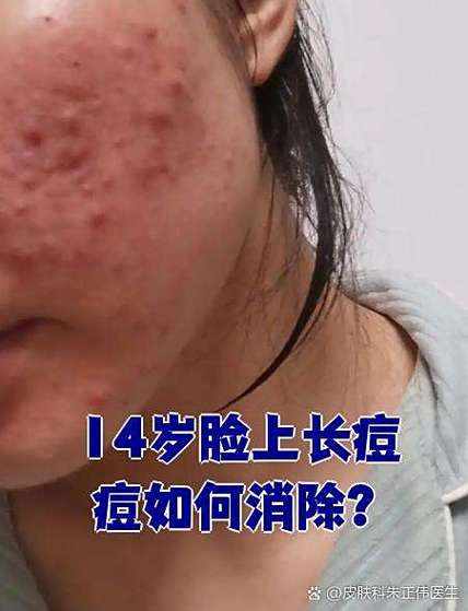 长痘痘的烦恼心情说说缩略图
