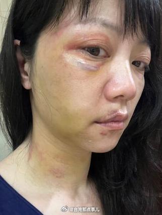 打伤脸部淤青的图片