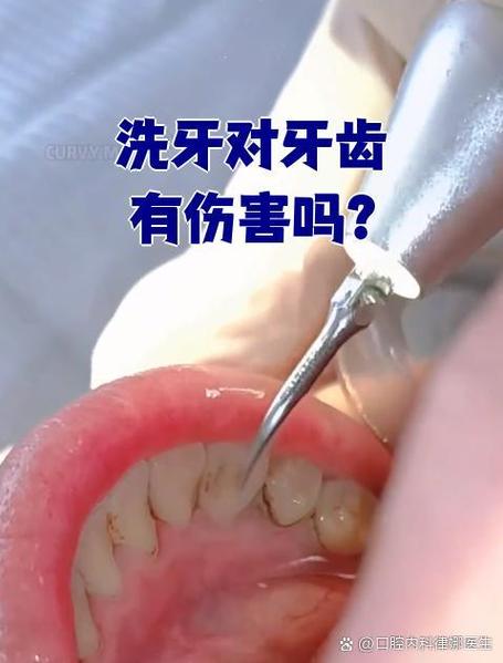 超声波洗牙疼吗