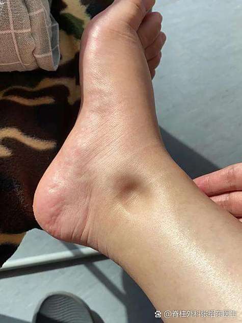 脚肿按一下就凹下去了