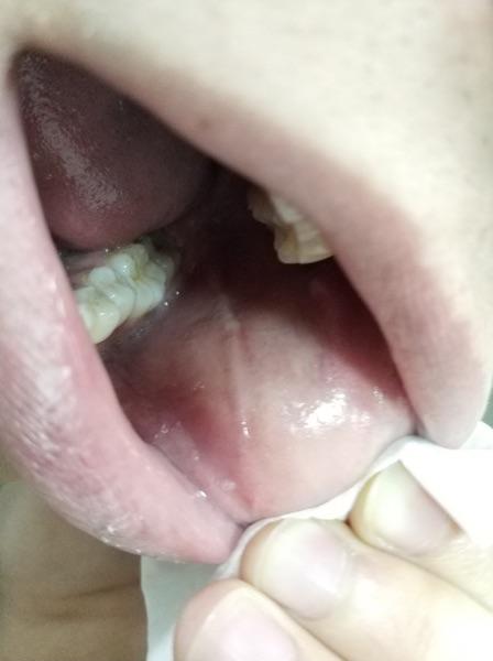 左脸内测长了白线