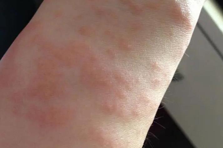 手腕痒