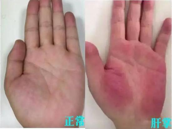 肝病手黄是怎样的图片