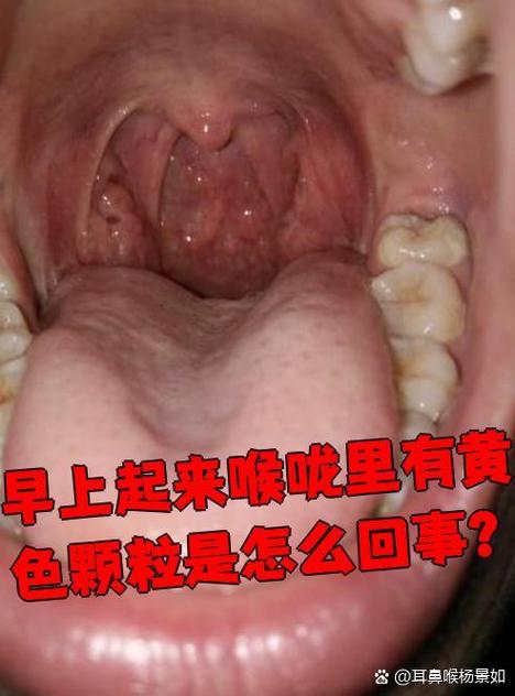 咽喉出来黄颗粒捏碎很臭