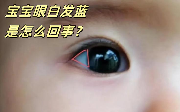 眼白出现蓝斑是什么病兆