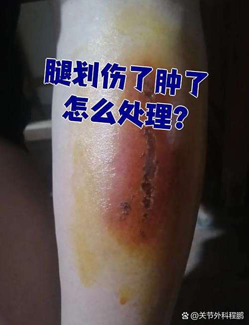 scum腿受伤了怎么治疗