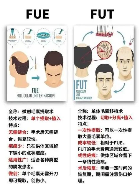 移植头发能保持多久