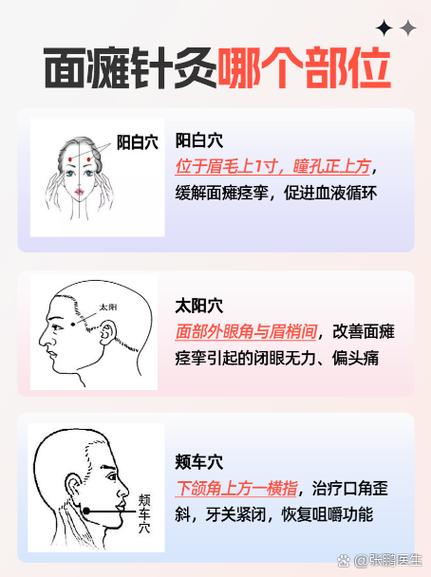 针灸面瘫定位图
