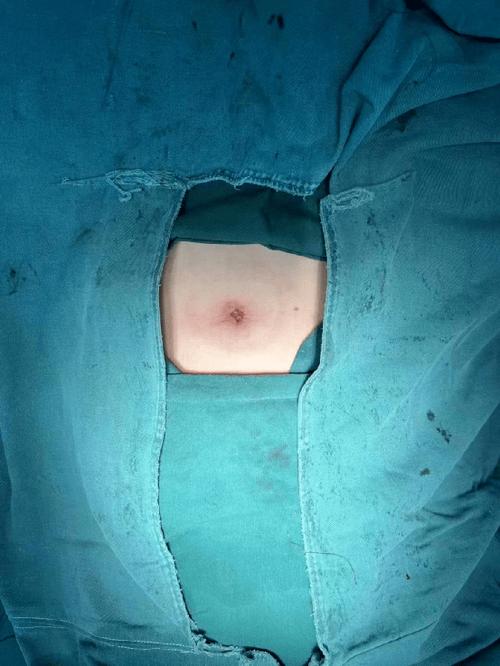 实体性包块