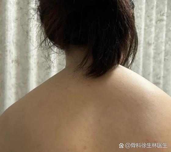 溜肩怎么练成平肩