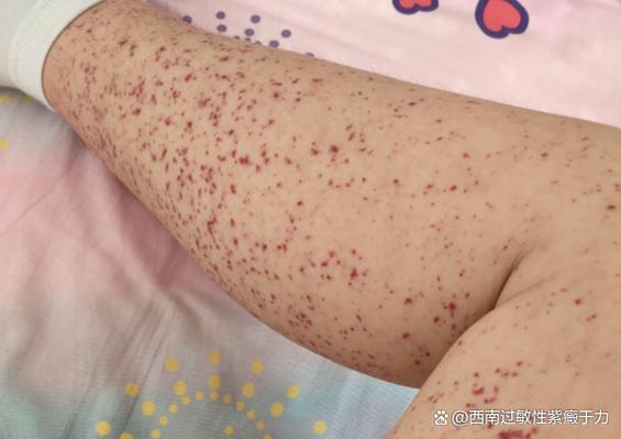 过敏性紫癜能自愈吗