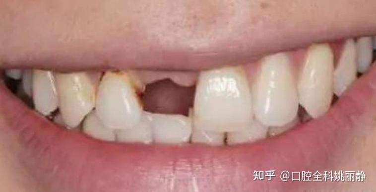 牙齿缺口会自己修复吗