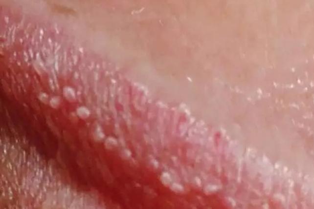 龟 头上有丘疹图片和症状