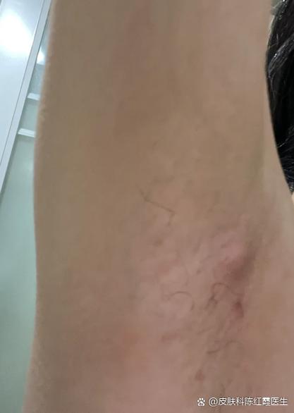 液窝痒是怎么回事