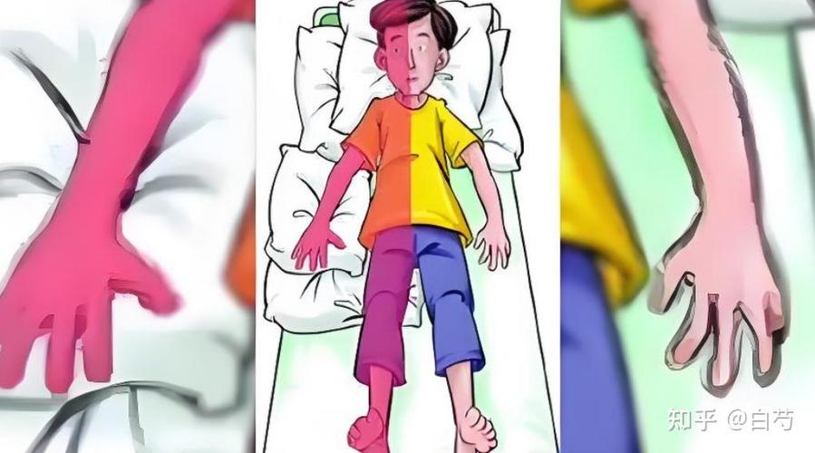 格林巴利综合征的临床表现