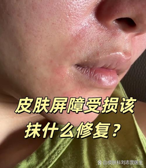 脸部屏障受损会自动恢复吗