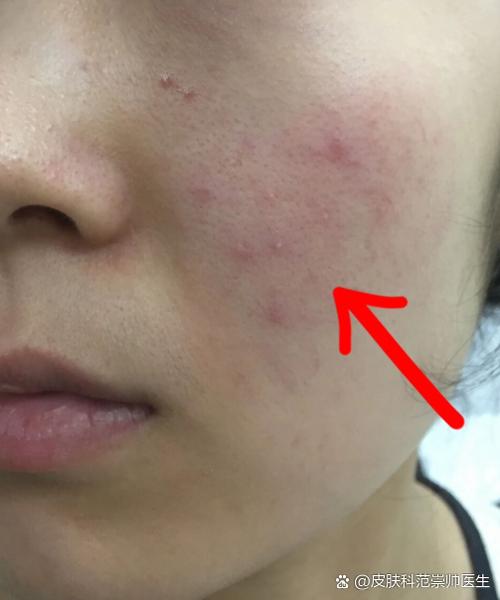女孩子说脸上长痘痘怎么回复缩略图
