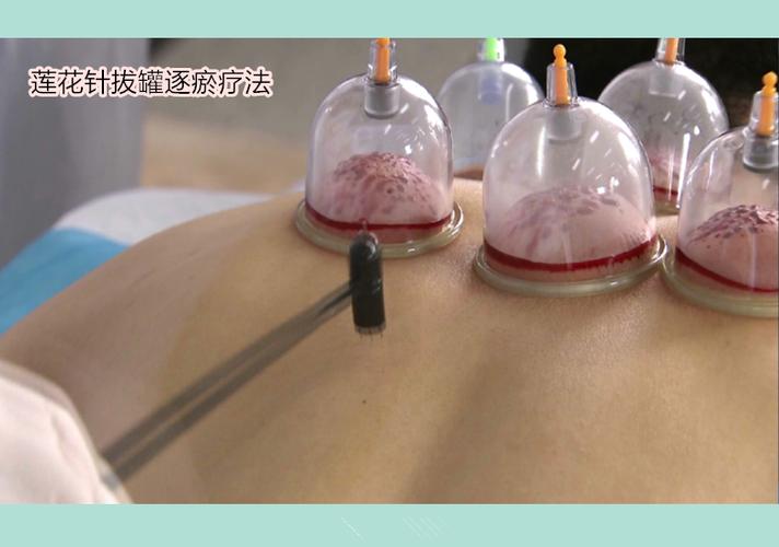 拔罐器多少钱一套20个罐