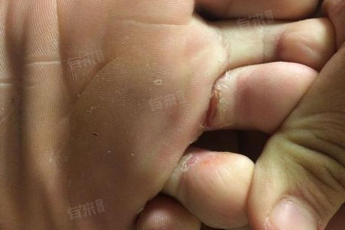 两个脚趾中间裂开一道缝疼