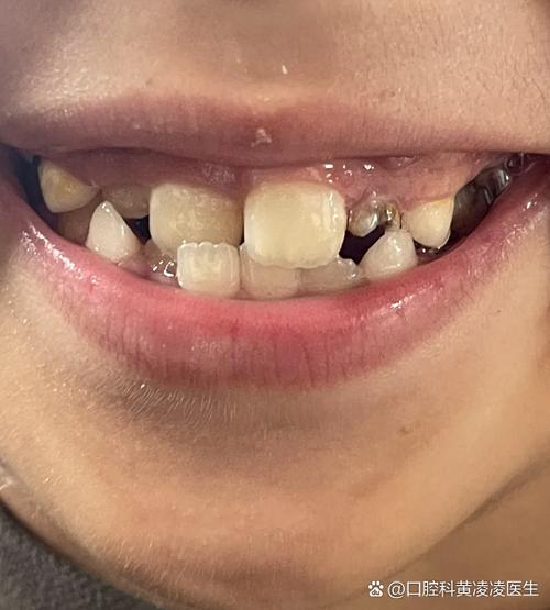 牙歪了还能恢复正常吗截图
