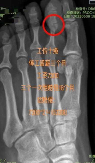 脚趾骨折算几级伤残