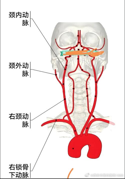 颈动脉一旦开刀就意味着什么