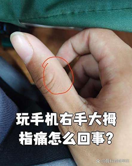 玩手机游戏大拇指变形截图