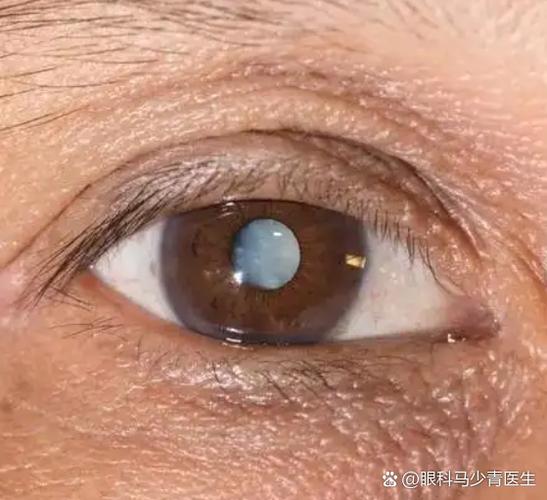 眼睛黑暗中有一块看不清