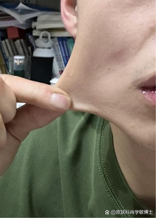 男士脸皮松弛最有效的方法