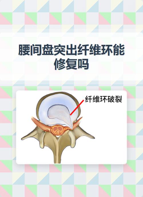 纤维环撕裂怎么锻炼