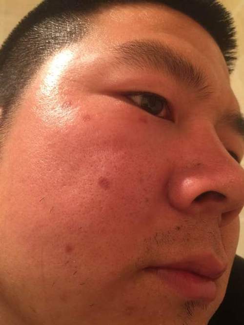 脸上出现红色圆形印子