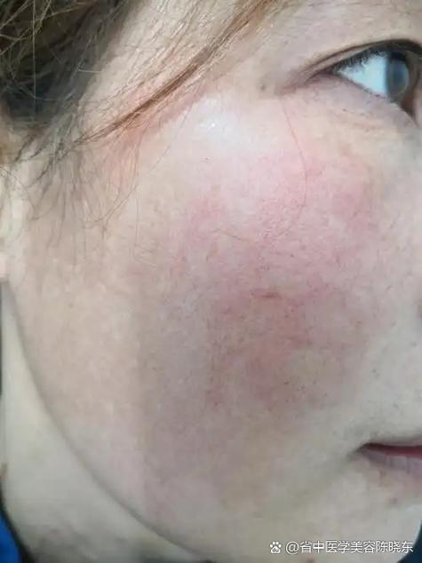脸泛红角质层薄怎么修复