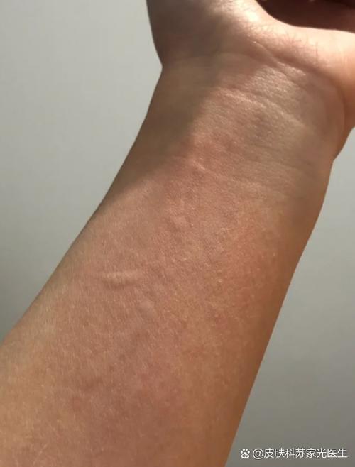 身上一直痒一抓就起小疙瘩截图