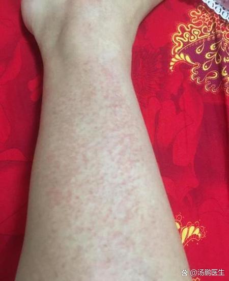 身上痒挠完有红色血点