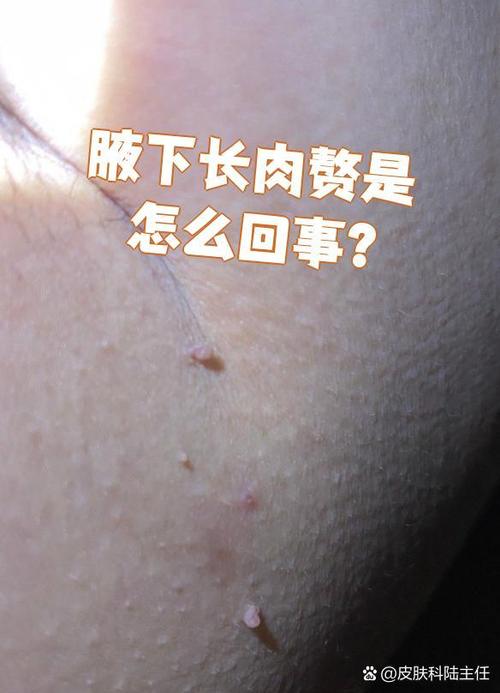 腋下长了个小肉揪揪