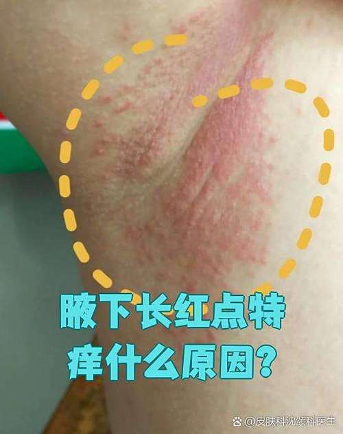 腋窝总是痒是怎么回事