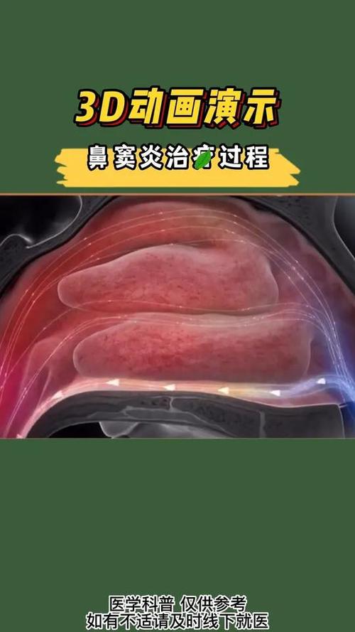 鼻窦炎变好的三个过程截图