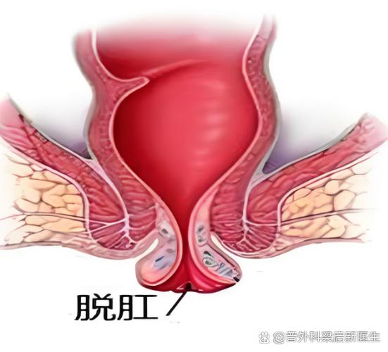 大便脱肛简单治疗方法